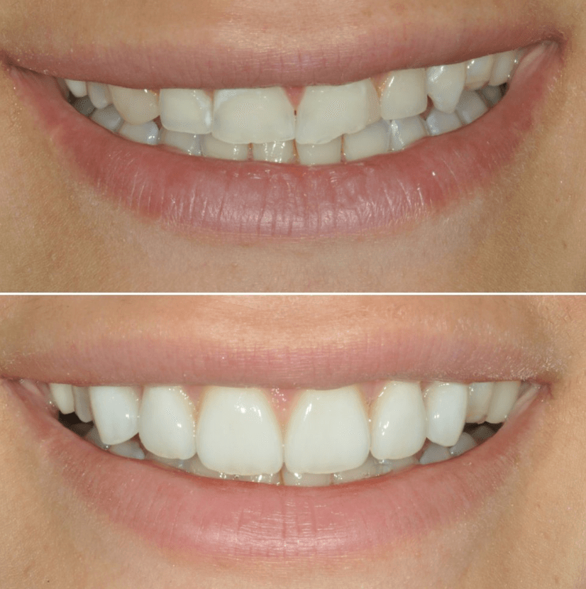 Before & After Photo