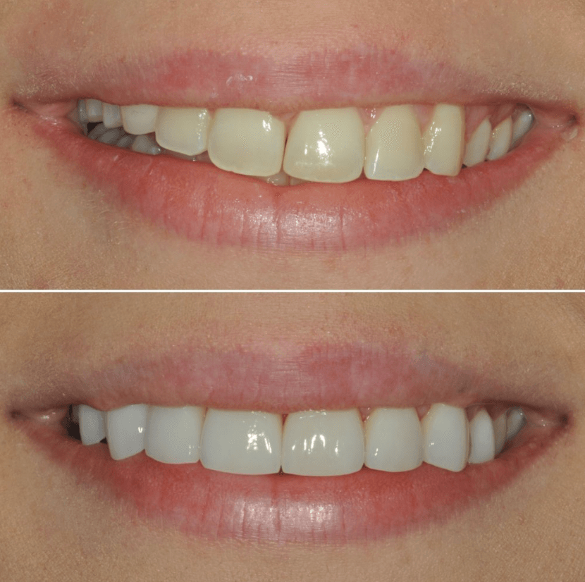 Before & After Photo