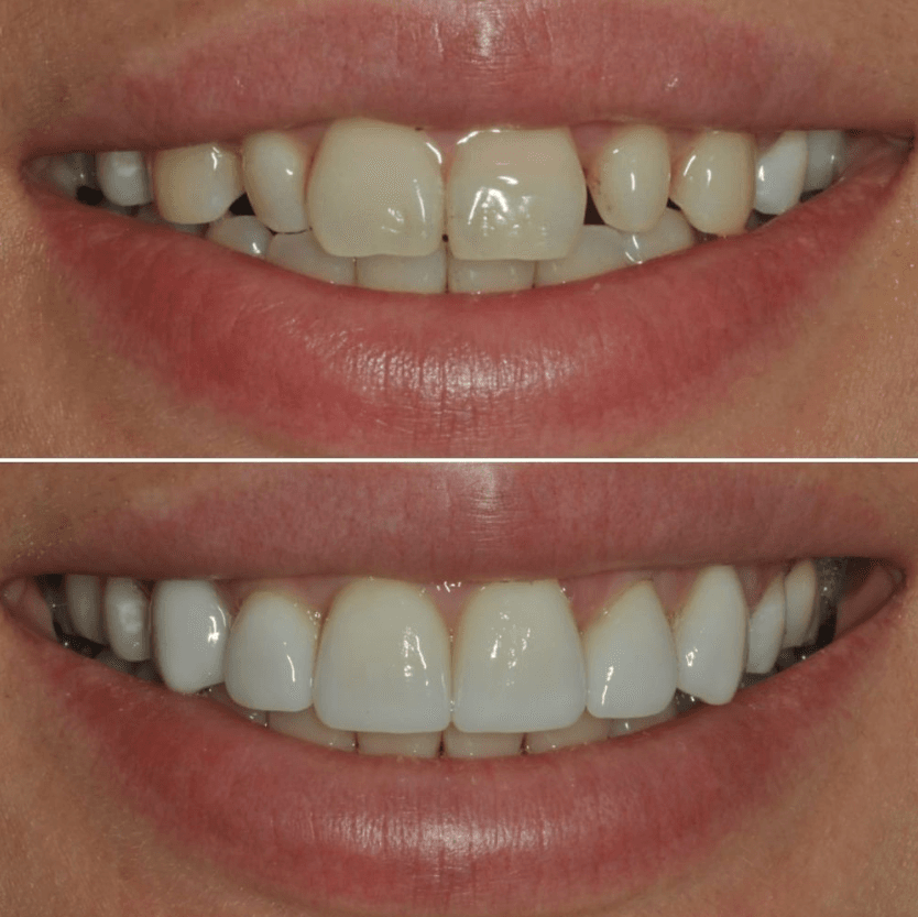 Before & After Photo