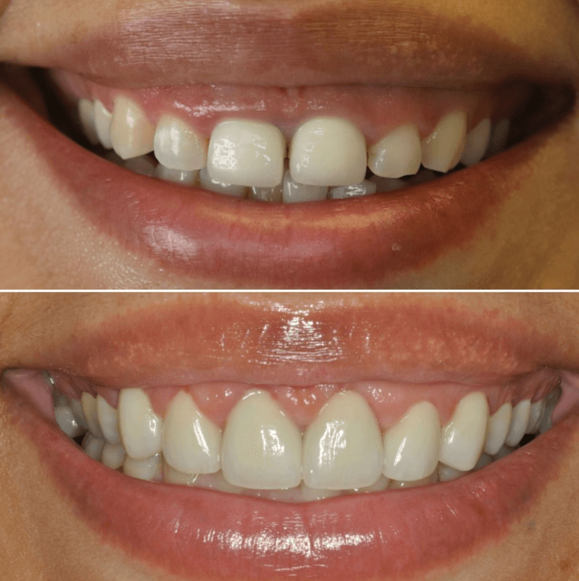 Before & After Photo