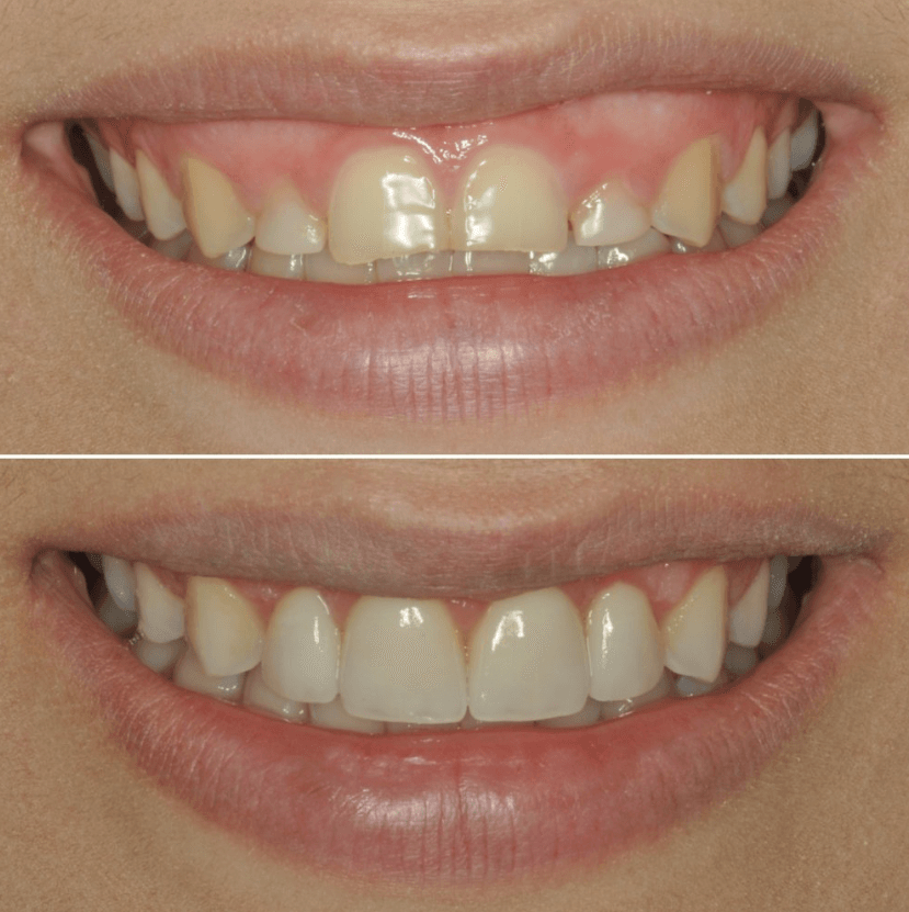 Before & After Photo