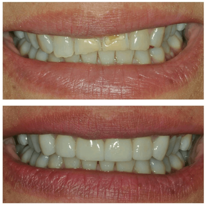 Before & After Photo