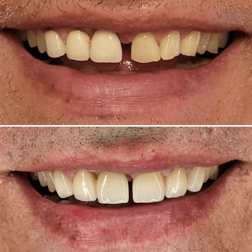 Before & After Photo
