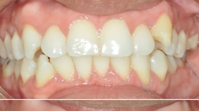 Before & After Photo