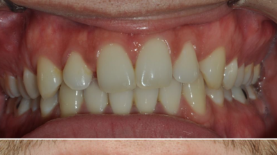 Before & After Photo