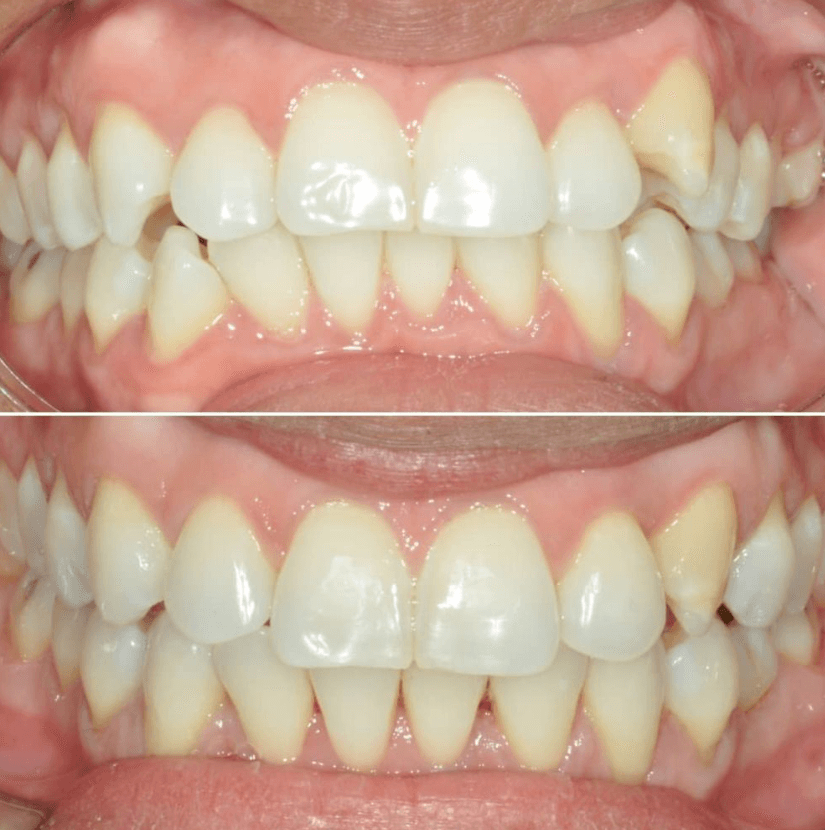 Before & After Photo