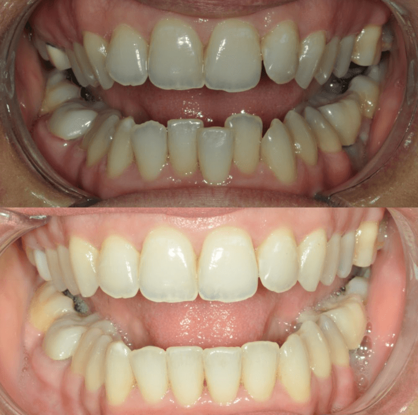 Before & After Photo