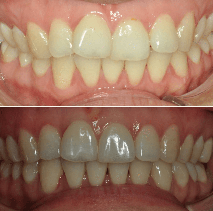 Before & After Photo