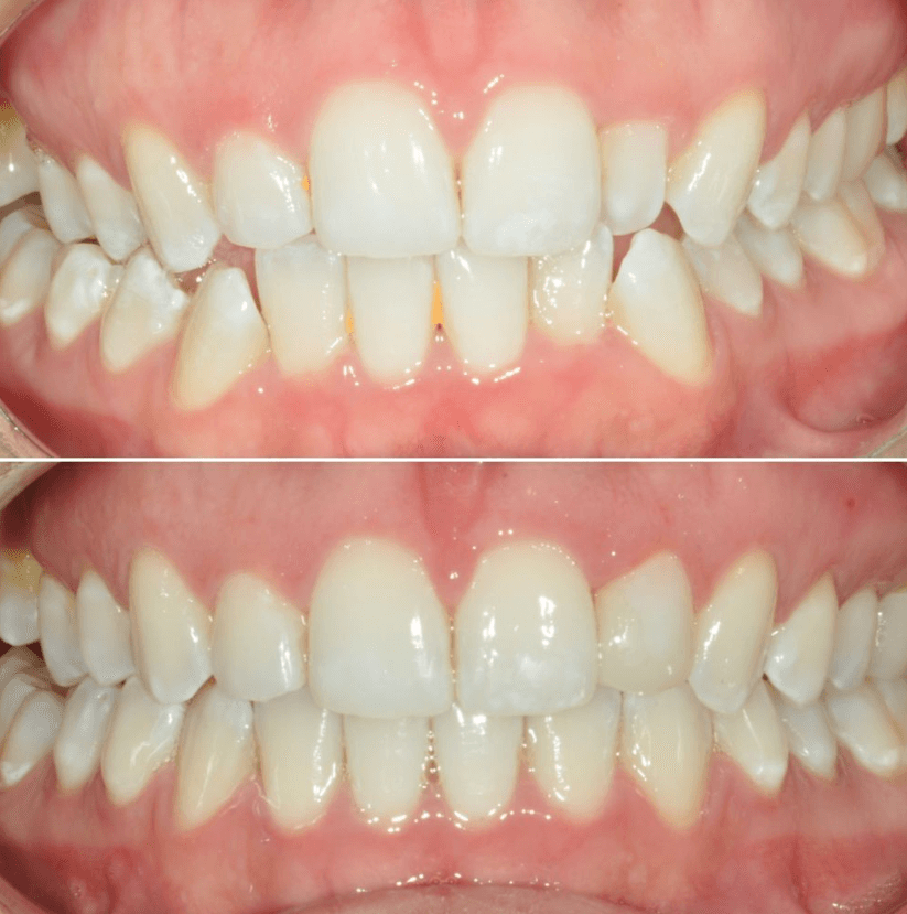 Before & After Photo