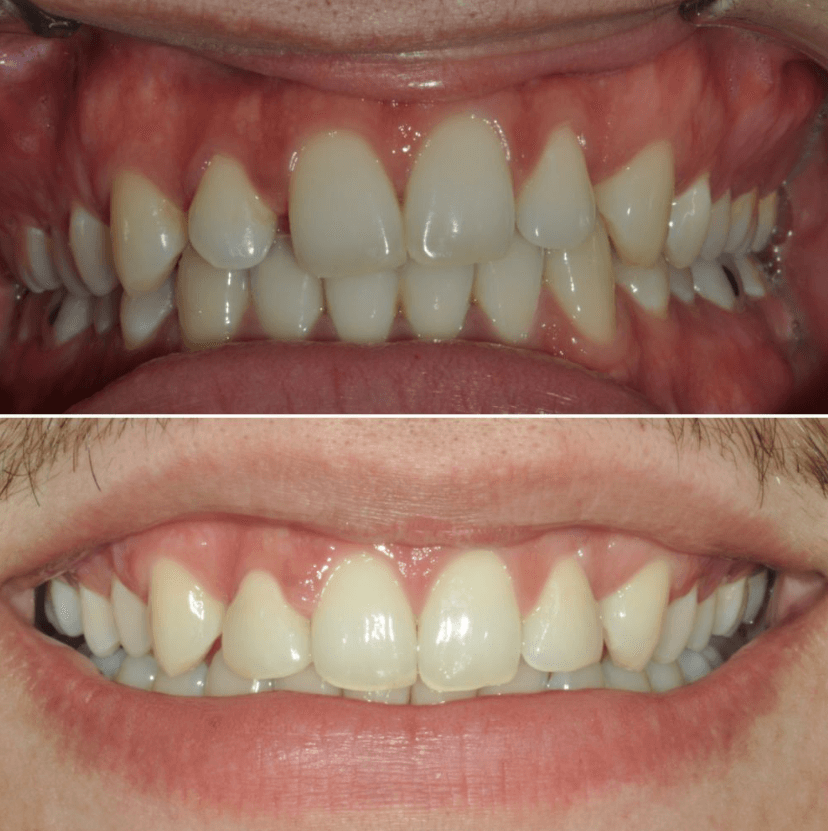 Before & After Photo