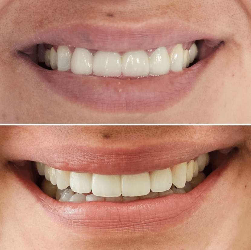 Before & After Photo